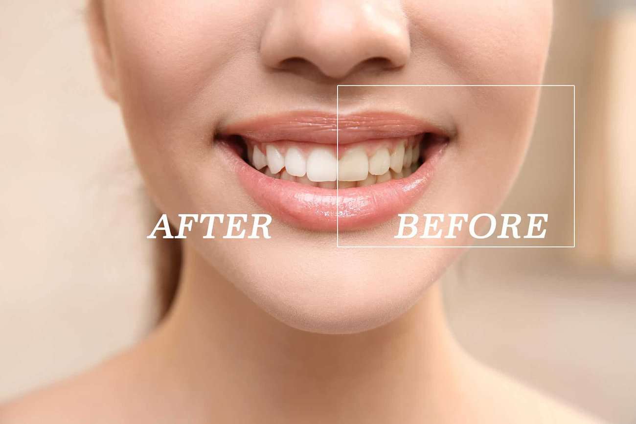 How Can You Maintain a Consistent Smile Shade with Crowns Luton?