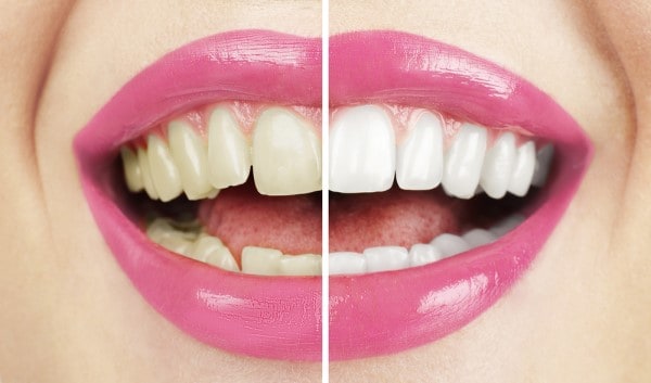 What Makes Ultima White Teeth Whitening Different Luton