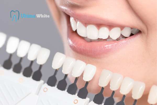 How to Maximise the Results of Your Laser Teeth Whitening Treatment Luton
