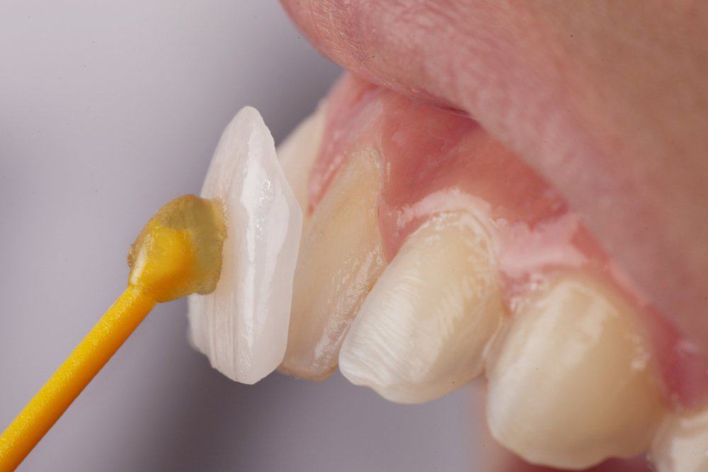 Dental Veneers: Achieving a Flawless Look Luton