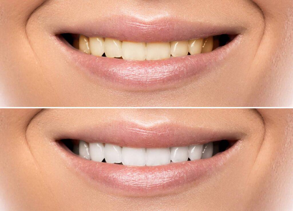 How Can You Protect Your White Smile as a Coffee Lover Luton?