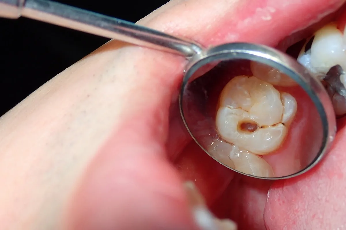 Why Do Teeth Crack? Common Causes to Know Luton