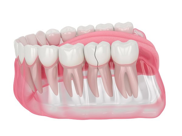 How Can You Manage Pain and Discomfort After a Root Canal Luton?