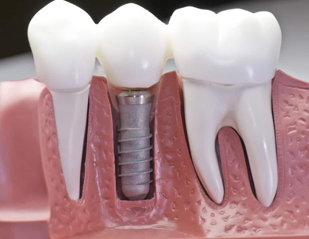 Common Misconceptions About Modern Dental Treatments Luton