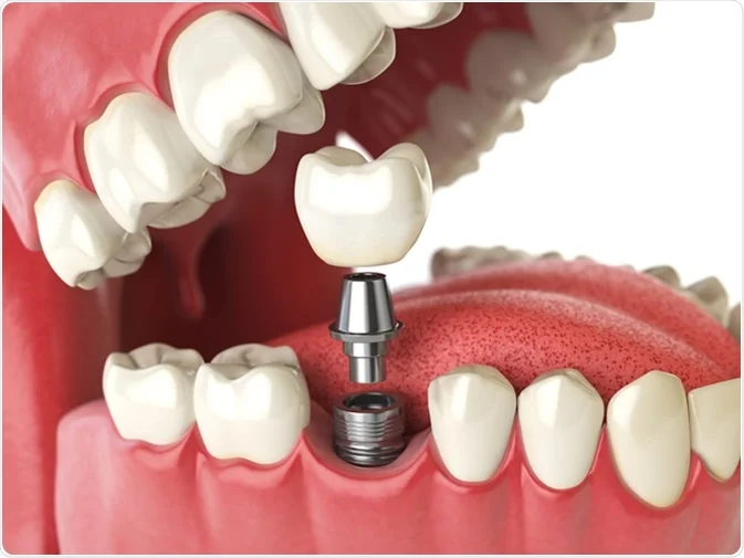 How Do I Decide Which Tooth Replacement Is Right for Me Luton?