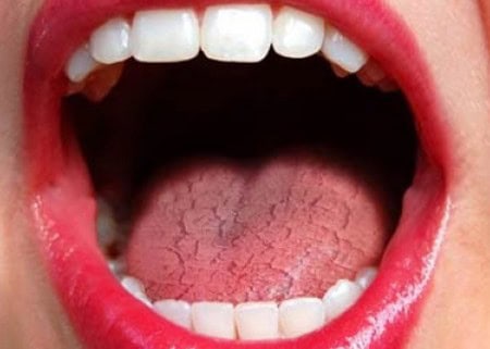 Common Causes of Dry Mouth (Xerostomia) Luton
