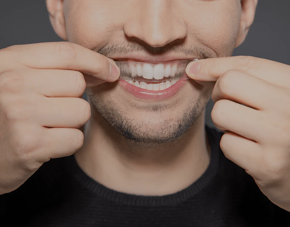 Can You Whiten Natural Teeth Without Harsh Chemicals Luton?