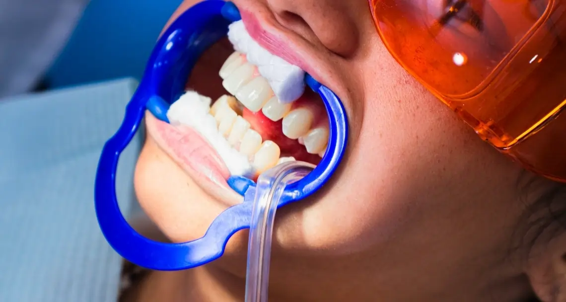 What Side Effects Can You Experience After Laser Teeth Whitening Luton?