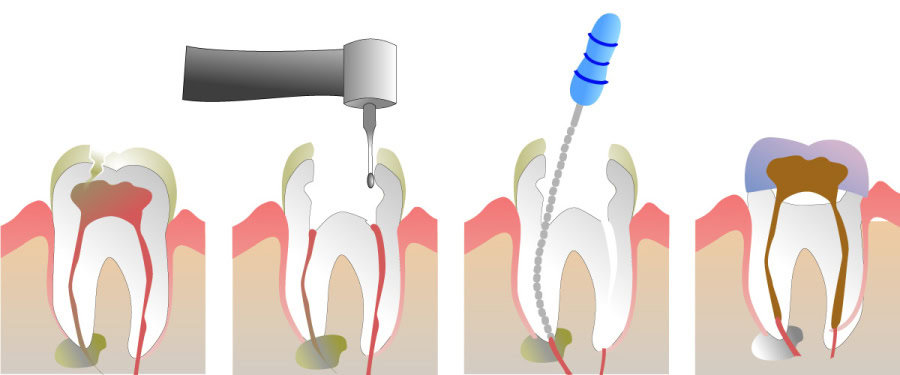 How Do You Properly Care for Your Teeth After a Root Canal Luton