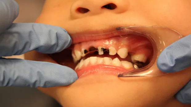 Tips for Keeping Your Child’s Baby Teeth Healthy and Strong Luton