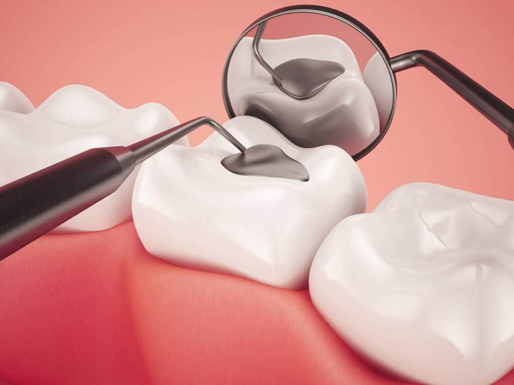 Fighting Cavities and Plaque Buildup Luton