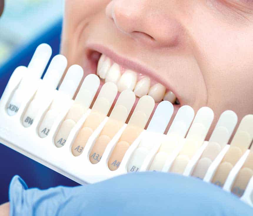 Professional vs At-Home Whitening: What You Need to Know Luton