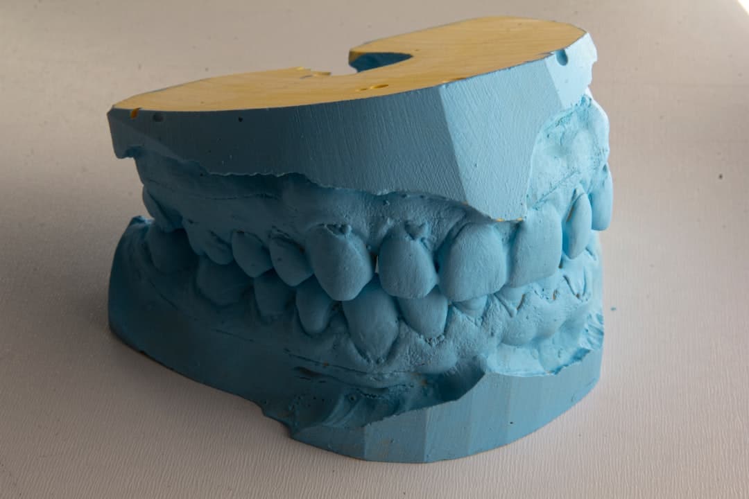How Do Dental Implants Improve Jawbone Health and Oral Function Luton?