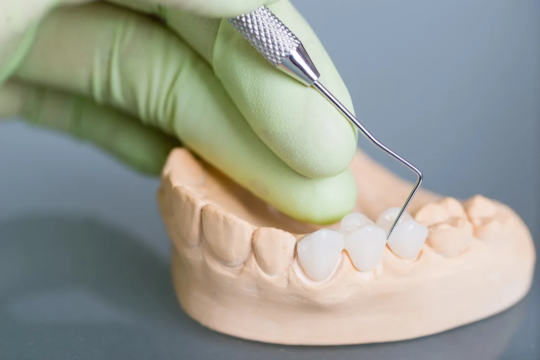 Do Braces Take Years to Show Results Luton
