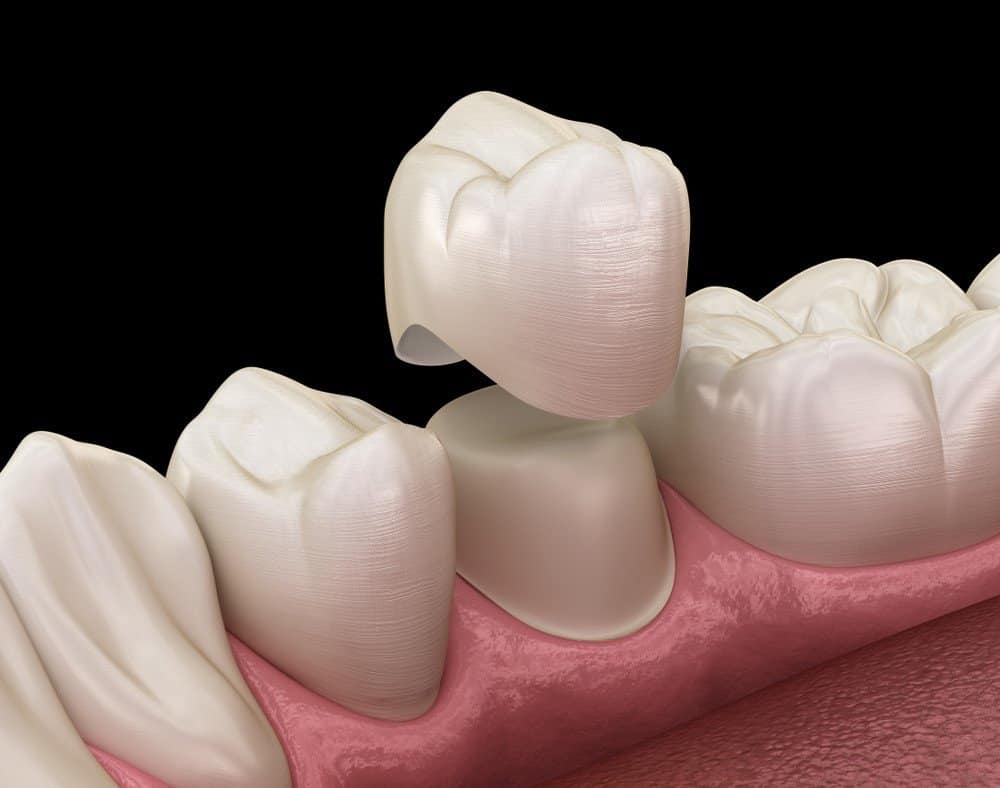 Teeth Whitening: Separating Facts from Fiction Luton