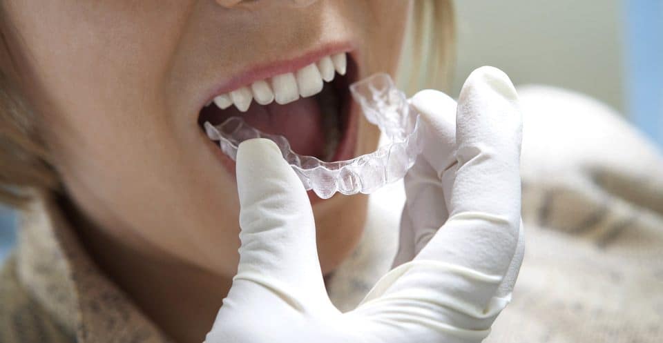 How Much Does Laser Teeth Whitening Cost Compared to Overnight Trays Luton?