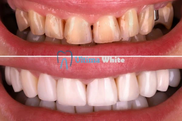 What Makes Instant Teeth Whitening Treatments So Popular Luton?