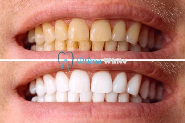 Stained Teeth and Persistent Bad Breath Luton